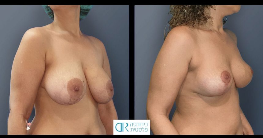 removal-breast-implants-11B-re-mastopexy