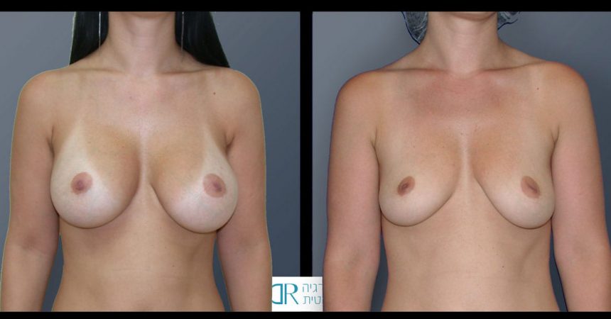 removal-breast-implants-20A