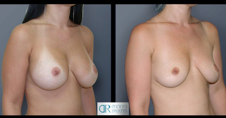removal-breast-implants-20B