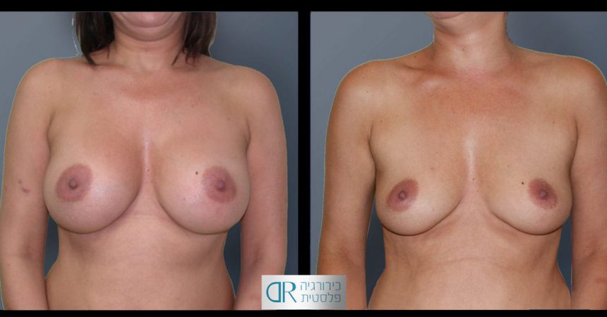 removal-breast-implants-21A