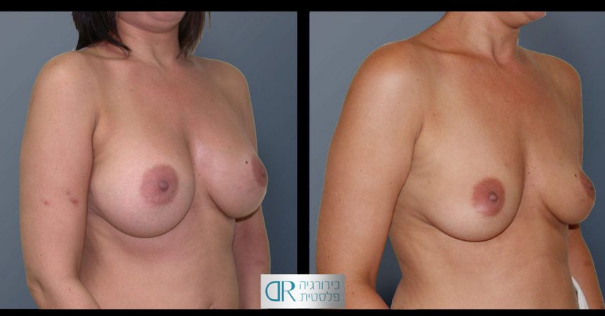 removal-breast-implants-21B