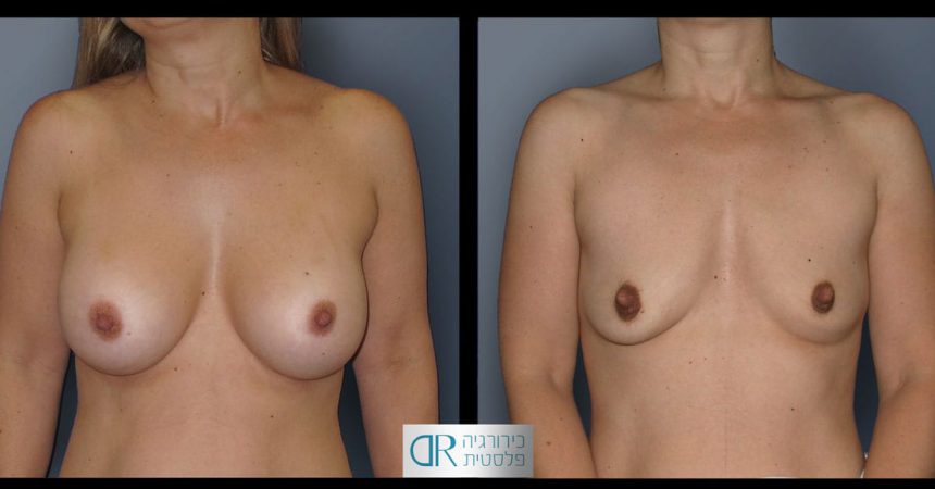 removal-breast-implants-22A