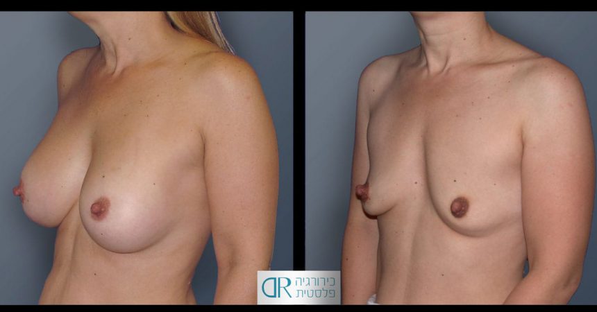 removal-breast-implants-22B