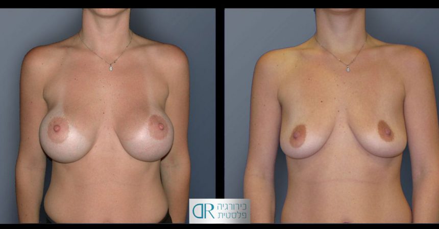 removal-breast-implants-23A