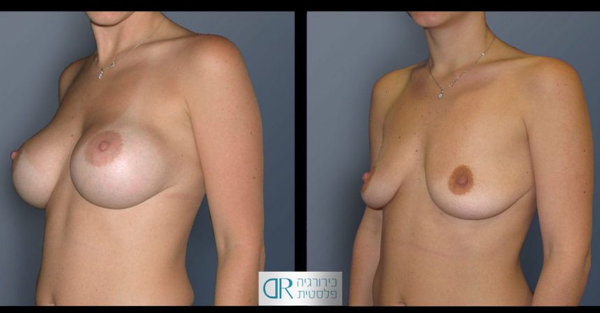 removal-breast-implants-23B