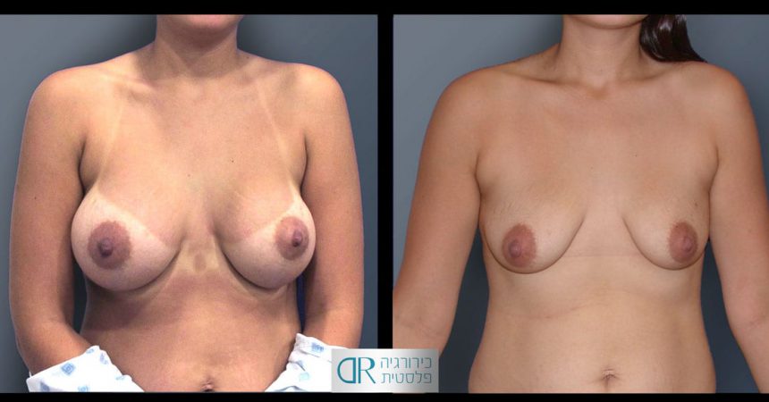 removal-breast-implants-24A