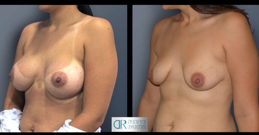 removal-breast-implants-24B