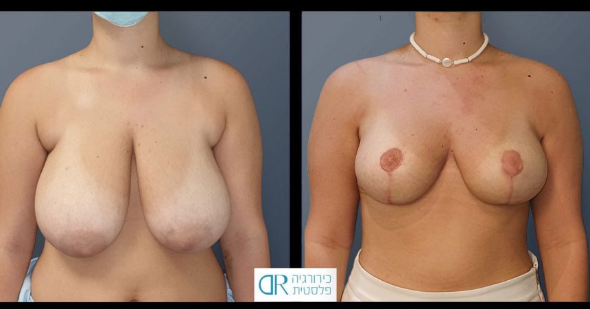 accessory-breast-&redudction-A1
