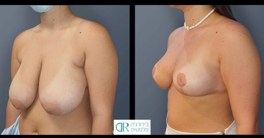 accessory-breast-&redudction-A3