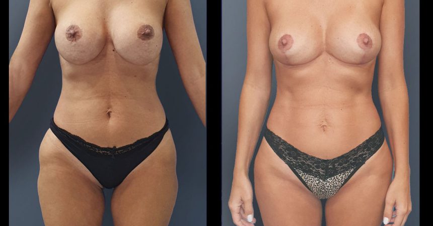 breast-pexy-liposuction2
