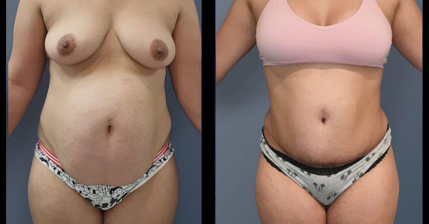 POVH-repair-and-abdominoplasty1A