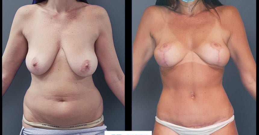 breast-pexy-abdominoplsty-5A