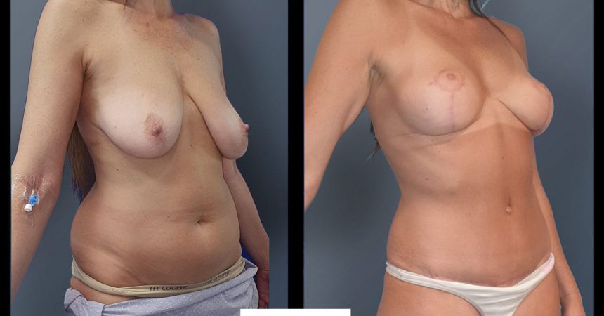 breast-pexy-abdominoplsty-5B