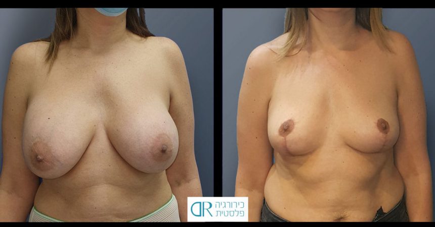 removal-breast-implants-30A