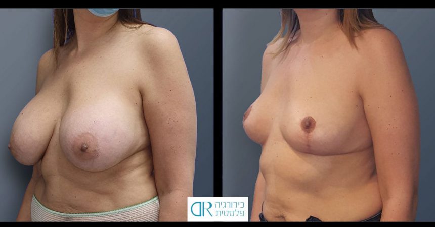 removal-breast-implants-30B
