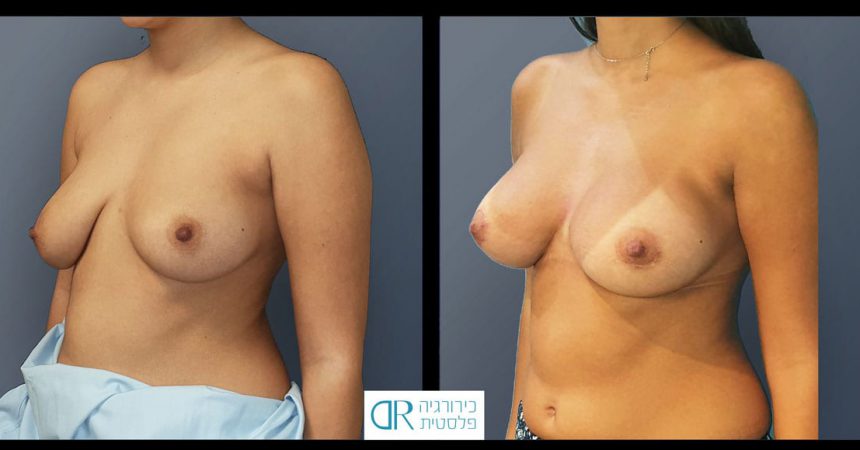 breast-asymmetry-10B
